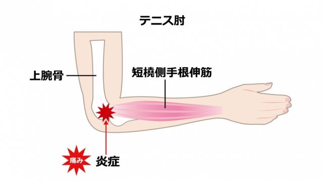 テニス肘